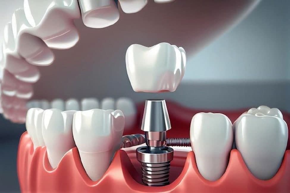 عوارض ایمپلنت دندان چیست؟ آیا کاشت دندان خطری دارد؟