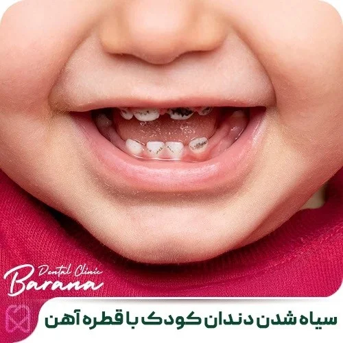 کودک علل تغییر رنگ دندان در نوزادان و کودکان نوپا