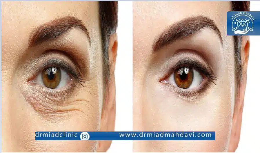 تاثیر فیلر زیر چشم روی سیاهی و چین و چروک های چشمی