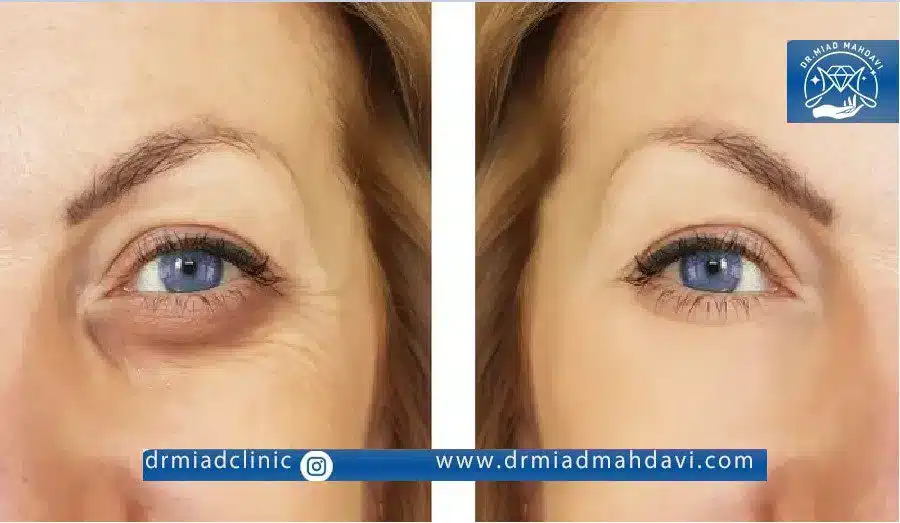 تاثیر تزریق فیلر زیر چشم روی جوانسازی پوست و حذف چروک